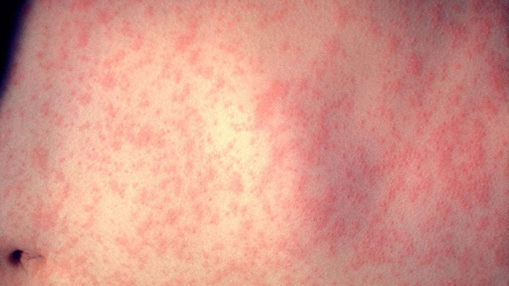 25 cases of measles identified in central, southeastern Minnesota, MDH says — WCCO / CBS Minnesota, Chaska Health news